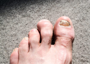 Hammertoe