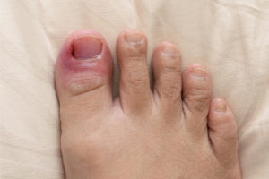 Ingrown Toenail