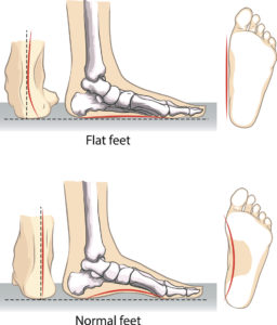 Flat Feet