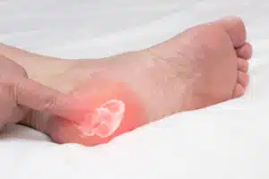 woman rubs a healing balm cream for the treatment of Plantar Fasciitis