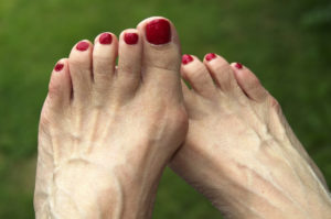 Lady with bunions