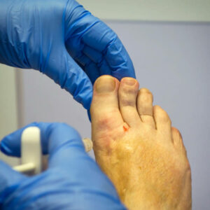 Local anaesthetic being injected into the big toe on a senior woman’s right foot prior to surgery for an ingrown toenail. Swelling and inflammation can be seen to the right side of the nail. The toe also shows a scar from previous surgery for arthritic changes to the joint. The surgery was undertaken in a podiatrist’s clinic under full surgical conditions.