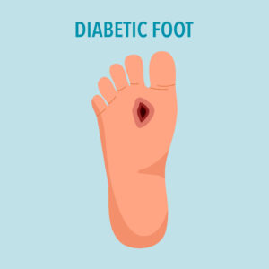 Diabetic foot syndrome concept vector illustration