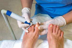 Ingrown Toenail operation in hospital