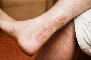 Scar from an operation to repair a snapped Achilles tendon.Camera: Canon 5D.