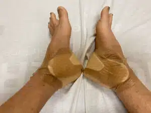 Patient feet after ankle surgery