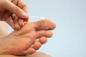 Image of a person applying ointment to remove plantar warts on her feet.