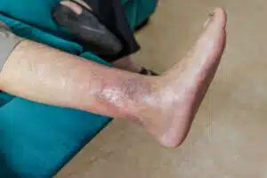 Image of a senior individual with a foot ulcer caused by diabetes.