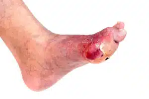 Image depicting a foot infection related to diabetes.