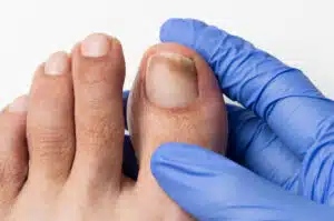 A person is examining their damaged toenail, which has been affected by a toenail fungus infection.
