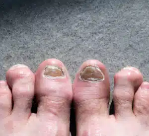 A male feet and toes affected by toe nail fungus and arhtritic hammertoes.