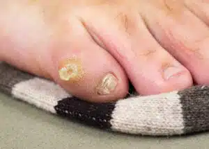 A big dry callus and misshapen nail on the little toe of a man's foot.