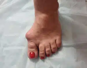 Close up image of a woman with a foot problem like bunion.