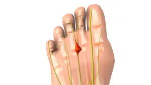 Pinched nerve or Morton's neuroma medical animation.