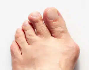 Male left foot with hallux valgus such as Bunion.