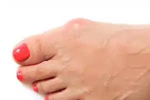 Varus valgus and Hallux valgus or bunion on middle aged woman foot.