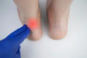 An orthopedic doctor examines a woman's leg for Achilles tendon and ankle diseases.