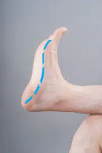 Male with flat feet and a foot with dashed line indicating medial arch shape.