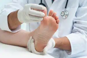 Tinia pedis or Athlete's foot